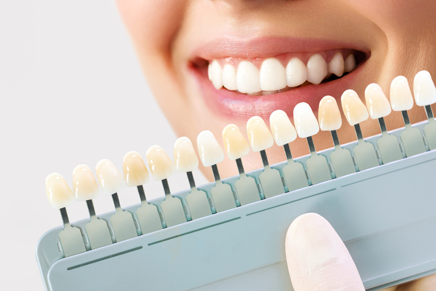 Veneers Pros And Cons