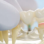 Dental Crown Procedure