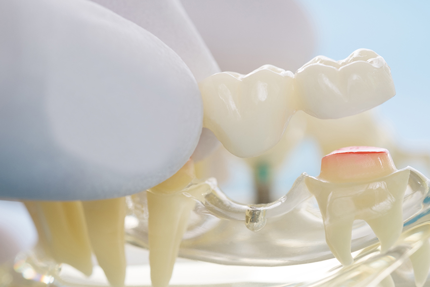 Dental Crown Procedure