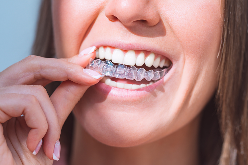 Invisalign Crowded Teeth