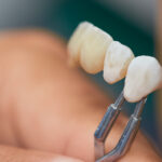 Dental Crown Benefits