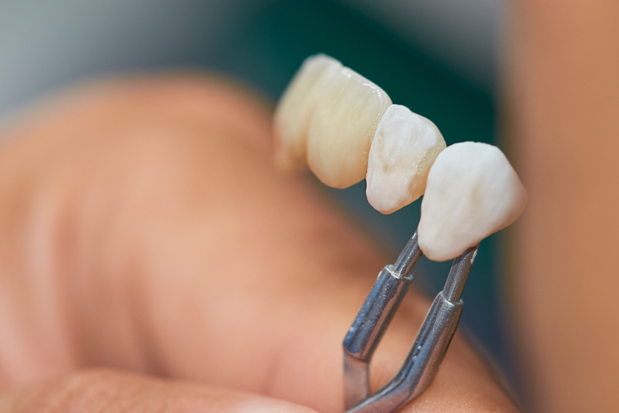 Dental Crown Benefits