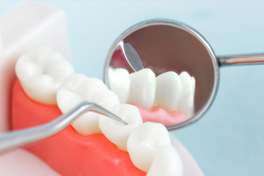 Dental Filling Benefits