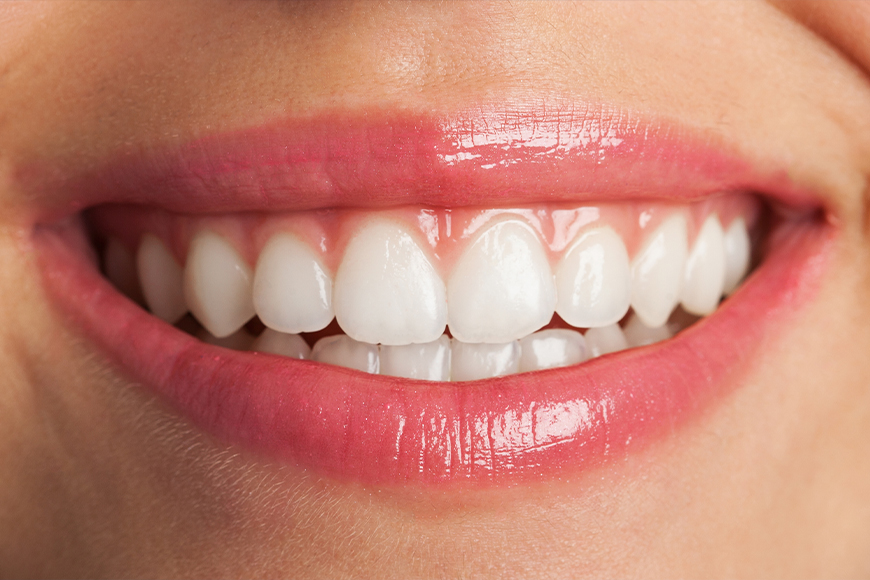 Can Veneers Fix My Overbite - Madison Dentistry & Implant Center - Madison, New Jersey