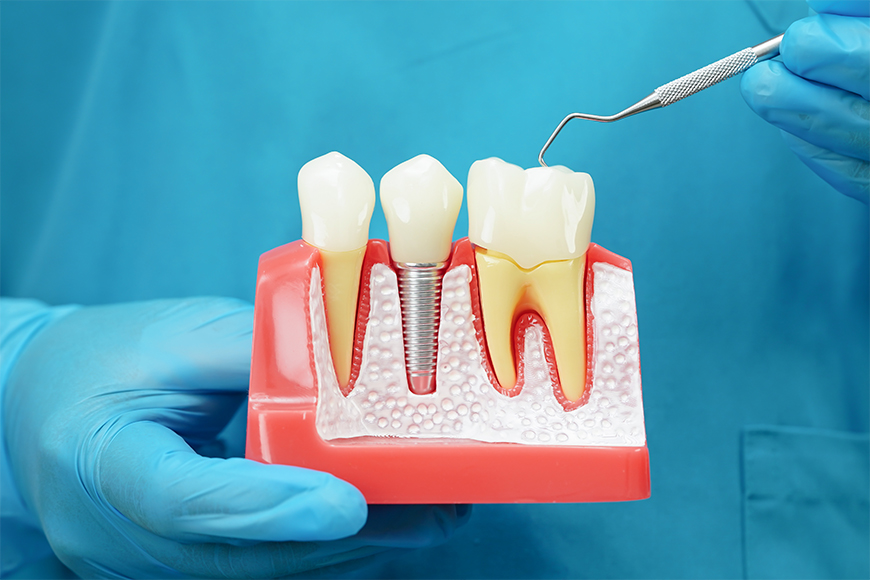 Dental Implant Procedure - Madison Dentistry & Implant Center - Madison, New Jersey