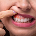 Tooth Stain VS Cavity - Madison Dentistry & Implant Center
