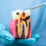 Root Canal Infection - Madison Dentistry & Implant Center - Madison, New Jersey