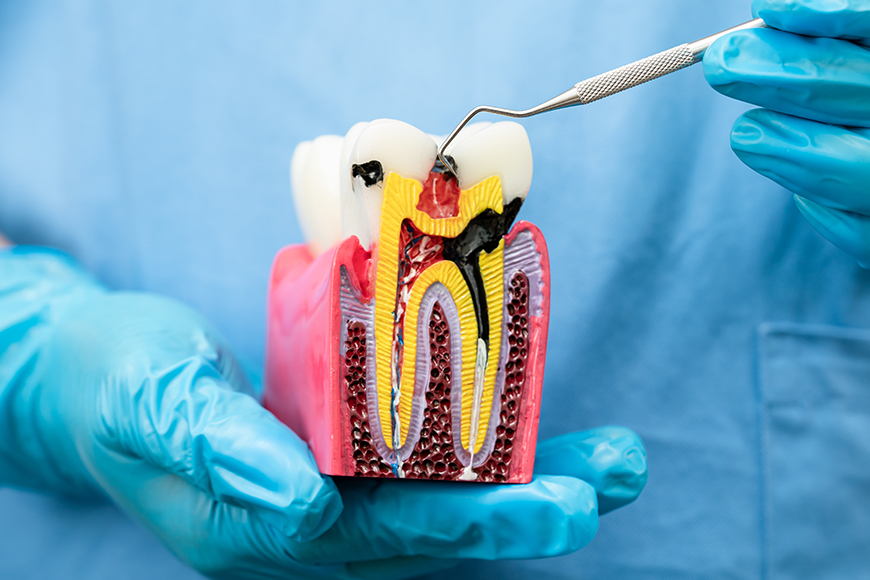Root Canal Infection - Madison Dentistry & Implant Center - Madison, New Jersey