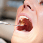 Emergency Tooth Extraction - Madison Dentistry & Implant Center - Madison, New Jersey