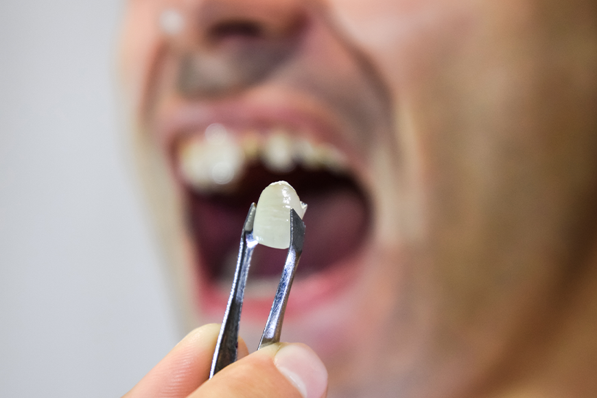 How To Stop Bleeding After Tooth Extraction