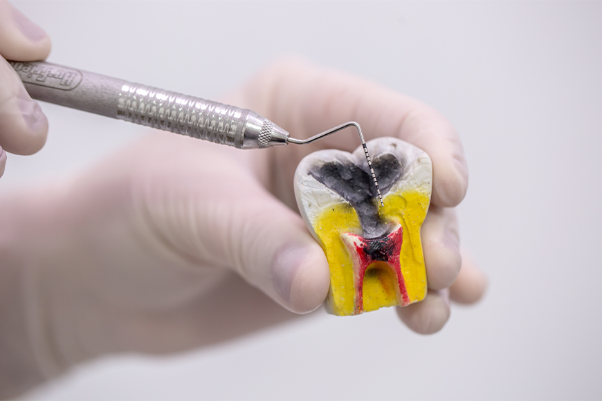 Root Canal Discoloration - Madison Dentistry & Implant Center - Madison, New Jersey