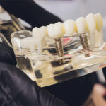 Full Mouth Dental Implants - Madison Dentistry & Implant Center - Madison, New Jersey