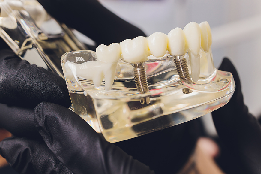 Full Mouth Dental Implants - Madison Dentistry & Implant Center - Madison, New Jersey