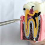 Emergency Root Canal Specialist - Madison Dentistry & Implant Center - Madison, New Jersey