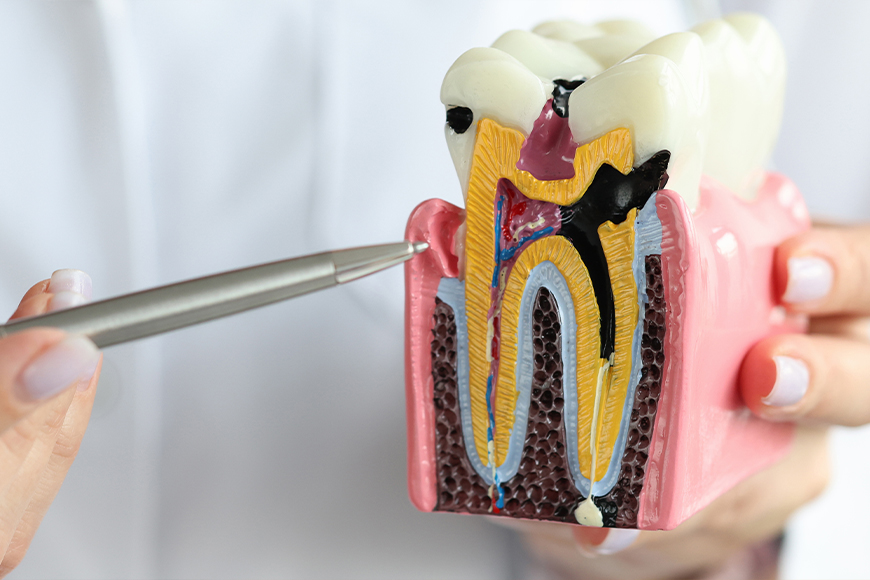 Emergency Root Canal Specialist - Madison Dentistry & Implant Center - Madison, New Jersey