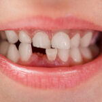 Chipped Tooth - Madison Dentistry & Implant Center - Madison, New Jersey