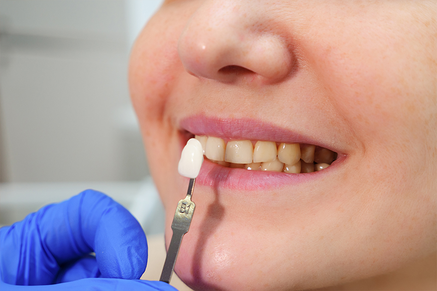 Dental Crown Repair - Madison Dentistry & Implant Center - Madison, New Jersey