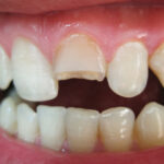 Cracked Tooth - Madison Dentistry & Implant Center - Madison, New Jersey