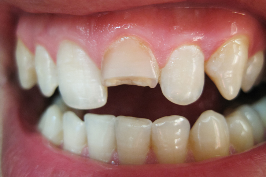 Cracked Tooth - Madison Dentistry & Implant Center - Madison, New Jersey