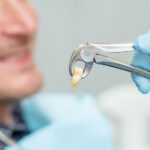 Cracked Tooth Extraction - Madison Dentistry & Implant Center - Madison, New Jersey