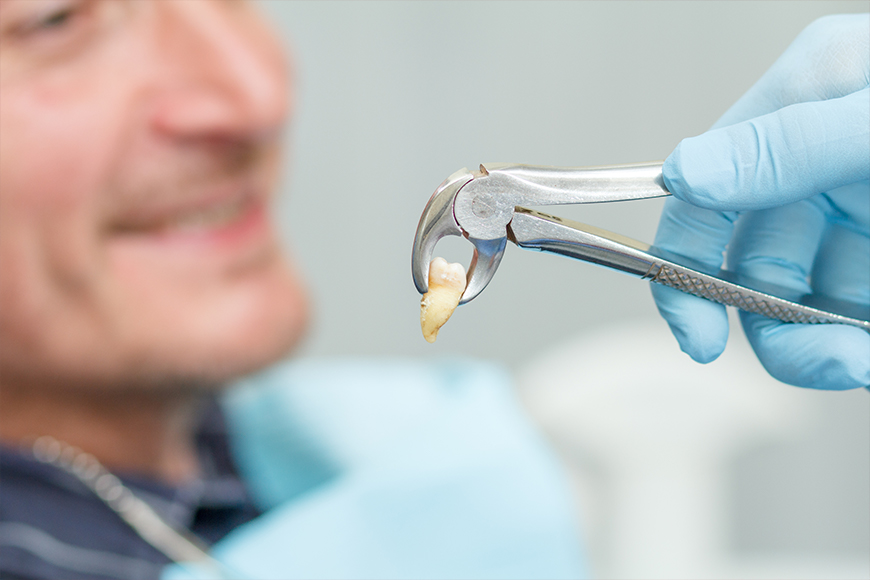 Cracked Tooth Extraction - Madison Dentistry & Implant Center - Madison, New Jersey