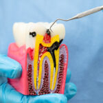 Emergency Root Canal Treatment - Madison Dentistry & Implant Center - Madison, New Jersey