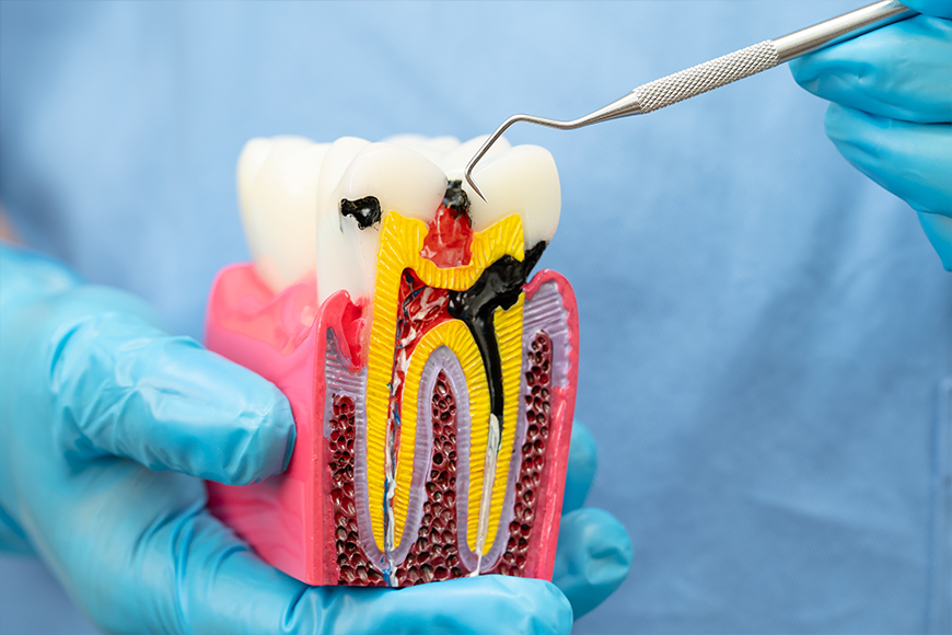 Emergency Root Canal Treatment - Madison Dentistry & Implant Center - Madison, New Jersey