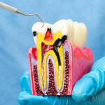 Root Canal vs Tooth Removal - Madison Dentistry & Implant Center - Madison, New Jersey