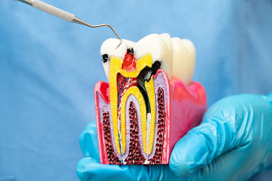 Root Canal vs Tooth Removal - Madison Dentistry & Implant Center - Madison, New Jersey