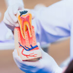 Can a Root Canal Get Infected - Madison Dentistry & Implant Center - Madison, New Jersey