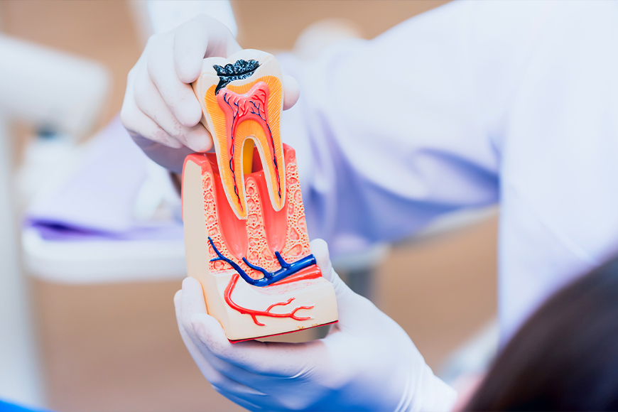 Can a Root Canal Get Infected - Madison Dentistry & Implant Center - Madison, New Jersey