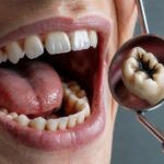 Tooth Infection Treatment - Madison Dentistry & Implant Center - Madison, New Jersey