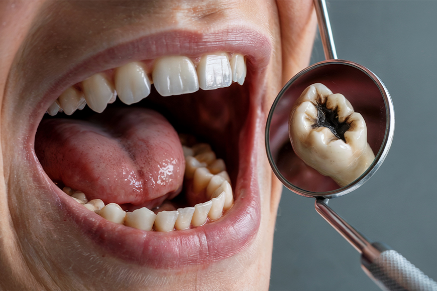 Tooth Infection Treatment - Madison Dentistry & Implant Center - Madison, New Jersey