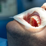 Gentle Tooth Extraction