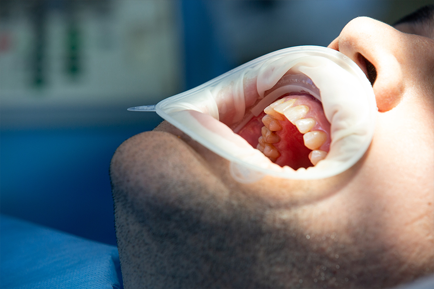Gentle Tooth Extraction