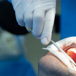 Wisdom Teeth Removal NearMe